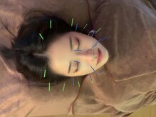 井荻癒し鍼灸院/美容鍼