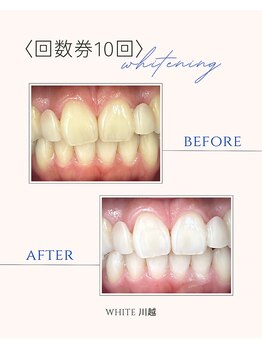 ホワイト 川越店(WHITE)/歯のBefore→After