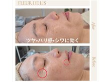 フルールドリス(FLEUR DE LIS)の雰囲気（ほうれい線・たるみ・目尻のシワ等にアプローチ！ぷるぷる肌に◎）