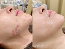 肌改善に自信あり♪何をしても良くならなかった方にオススメ！