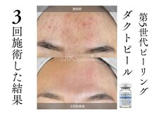 ララピール超え！酸不使用☆ダクトピールで爆速肌改善！！