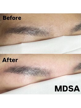 エムディーエスエー(MDSA)の写真/お手入れ不要の眉毛を目指すなら電気脱毛！デザイン込みでも、他店デザインで生えてきた眉もお任せ下さい♪