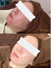 ミー(Mii)/国産ハーブピーリングでツヤ肌♪