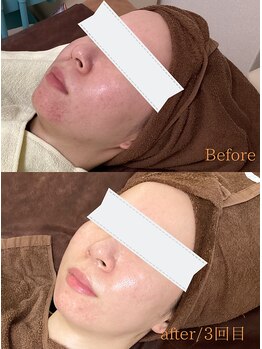 ミー(Mii)/国産ハーブピーリングでツヤ肌♪