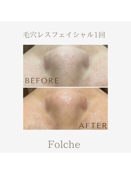 フォルチェ ゆめタウン広島店(Folche)/ごっそり毛穴洗浄!