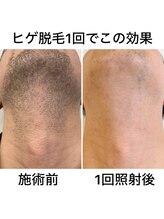 猫の手/【美肌脱毛】髭(男性)