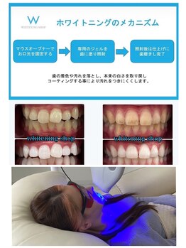ホワイトニングショップ 加古川店/ホワイトニングのメカニズム