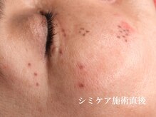 ラペッシュボーテ(La Peche Beaute)の雰囲気（未来のシミまで浮き彫りに!?溜まったシミ悩みが表面でアカになる）