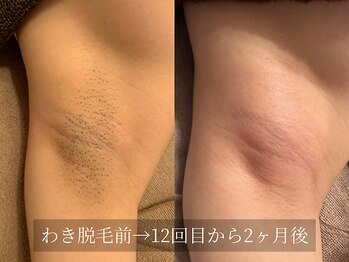 アルム(Arum)/わき脱毛