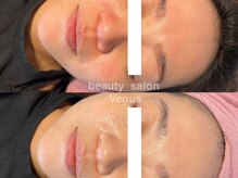 ヴィーナス(Venus)/ハーブピーリング・白玉スキン