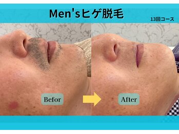 ケント整体院 ルース(KENT整体院 | Luz)/ヒゲ脱毛