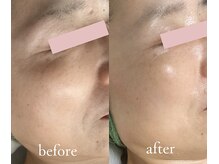 トリートメントルーム フェリーチェ(Felice)/本気の４か月「老け顔改善」