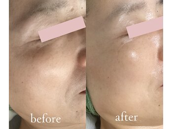 トリートメントルーム フェリーチェ(Felice)/本気の4か月「老け顔改善」