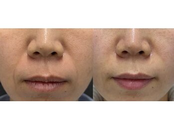毛穴専科の写真/＼最強リフトアップ￥4,980／「効果にびっくり」ほうれい線・たるみにお悩みの方へ！