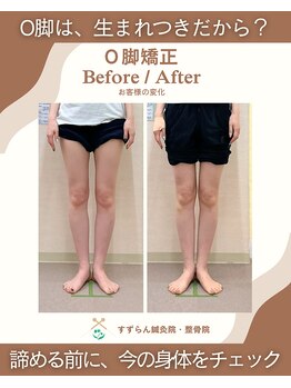 すずらん鍼灸院 整骨院の写真/O脚を諦めない！骨盤・姿勢・筋肉から整える、すずらんのO脚矯正
