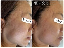 リードスラッシュ(LEAD/)/プロセルセラピーズお顔