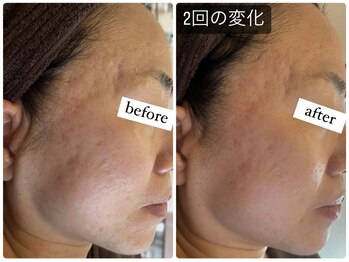 リードスラッシュ(LEAD/)/プロセルセラピーズお顔