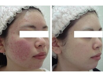 スマートポッシュ(Smart posh)/【ニキビケア】before→after