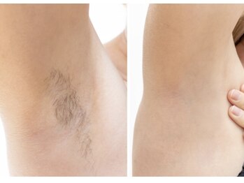 スムース イー(Smooth+E)/ワキ脱毛で黒ずみのないワキへ！