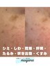 【HPB限定】シミケア20分＋シミco2パック