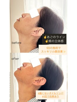 グリッタープラス(glitter plus)/小顔効果