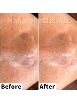 マハロハ 自由が丘(Mahaloha)/【シミケア・毛穴改善施術】