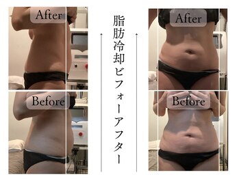クローネ(Krone)/脂肪冷却ビフォーアフター