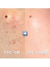 リラ(Lilas)/韓国肌ピーリング/ララピール