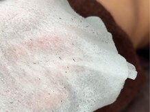 ボス 津店(BOSS)/施術後に抜けたヒゲ　#ヒゲ脱毛