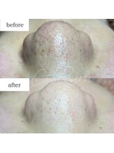 アルル(ARuru)/毛穴エクストラクション