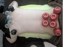 リデザイン 京都(REDESIGN)/中医カッピング療法