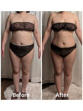 フィニシオン/40代　1ヶ月後の変化　4回施術