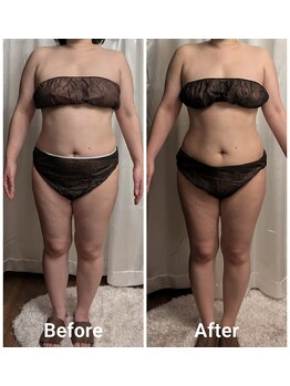 フィニシオン/40代　1ヶ月後の変化　4回施術