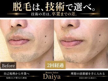 ダイヤ 名古屋中川区店(Daiya)の写真/「少ない回数で卒業したいなら技術で選べ。」ヒゲ・VIO特化◆全身脱毛も◎1回で実感、5回~10回で卒業多数！