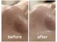 サンイチイチ(311)の写真/【毛穴悩み徹底ケア】開き毛穴、黒ずみ、テカリ、角栓詰まりなどの毛穴悩みに。ニキビ肌の方もおすすめ◎