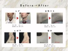 アネラ(anela)/脱毛befor → after