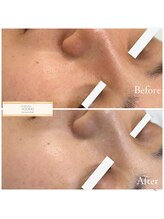 クレア(Clair)/フォーエバーヤング症例