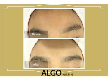 アルゴ 山口宇部店(ALGO)/キッズのお顔脱毛