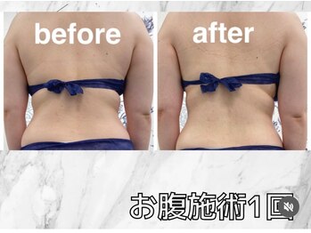 ハロ 南青山(HALO)/お腹ブラックスタンプ☆10PUSH