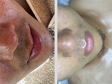 エムエー(MA)/肌育毛穴洗浄部分・髭脱毛