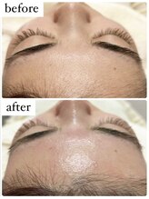 サロンドベルム(Salon de BELME)/シュガーリング：before/after