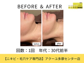 ア クーユ 多摩センター店/ レモンボトル/二重あご/小顔