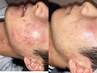 【ニキビ撲滅】肌荒れに悩む20代限定プラン★アクアダーマでトラブルケア