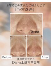 ディオーネ 上越南高田店(Dione)/毛穴洗浄&毛穴吸引