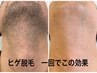 脱毛未経験メンズヒゲ脱毛体験　3500円