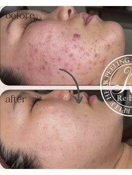 セレネ(SELENE)/ダウンタイムが取れない方へ