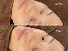 リアン(Lien)/水光肌ピーリング