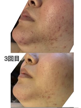 ウルワシ(Uruwashi)の写真/毛穴の開き・ざらつき・繰り返すニキビに◎肌悩みに合わせたハーブピーリング