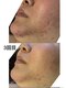 ウルワシ(Uruwashi)の写真/毛穴の開き・ざらつき・繰り返すニキビに◎肌悩みに合わせたハーブピーリング