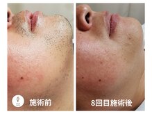 ヴォアール 名古屋店(VOIR)/ヒゲ脱毛８回目施術後